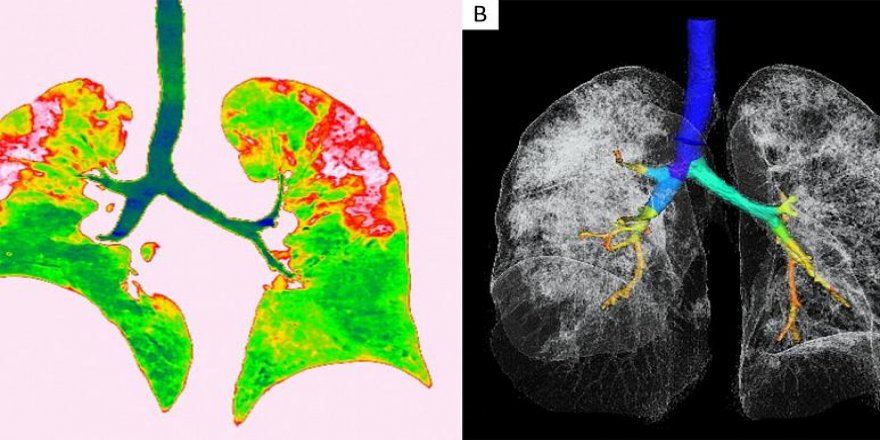 Covid-19'un akciğerlere verdiği zararı gösteren röntgen ve tomografi görüntüleri