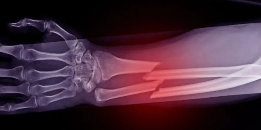 Çığır açan buluş: Kırıkları 3 dakikada onarıyor