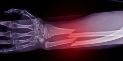 Çığır açan buluş: Kırıkları 3 dakikada onarıyor